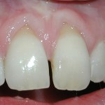 Gum graft - before treatment