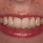 Crown lengthening - after procedure