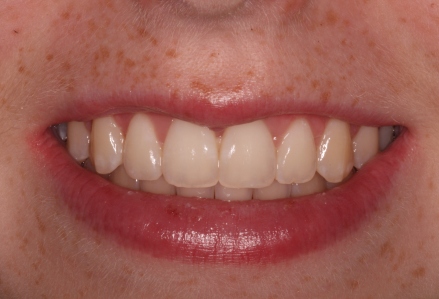 Crown lengthening - after procedure