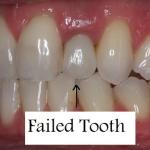 Patient with failed tooth - before
