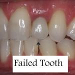 Patient with failed tooth - before
