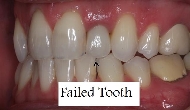Patient with failed tooth - before