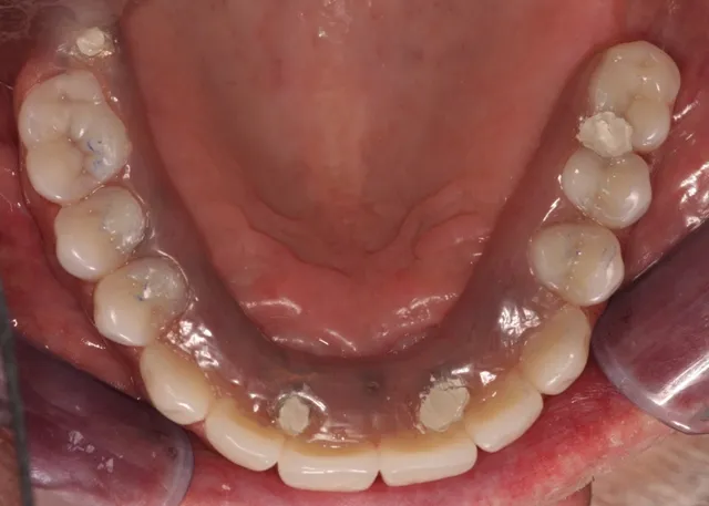 Patient with decayed teeth - after dental implants, view from below top teeth