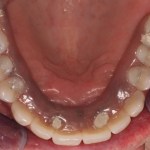 Patient with decayed teeth - after dental implants, view from below top teeth
