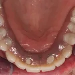 Patient with decayed teeth - after dental implants, view from below top teeth