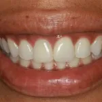 Patient with fractured tooth - after
