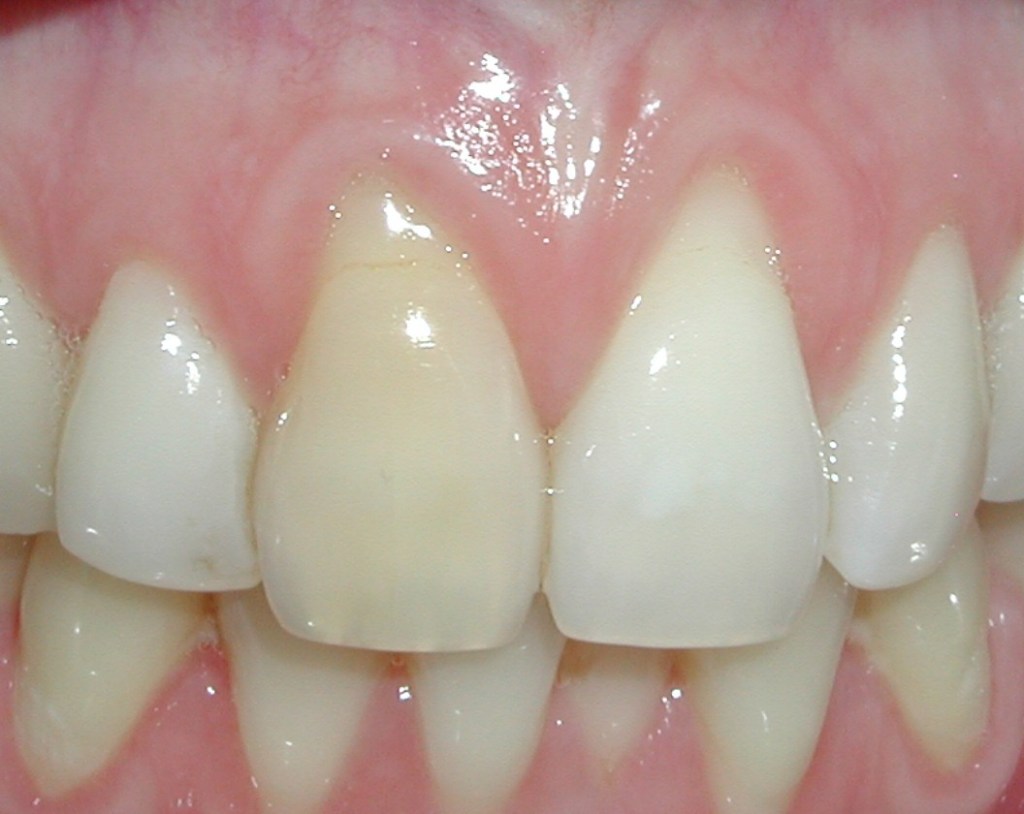 Gum grafting - before