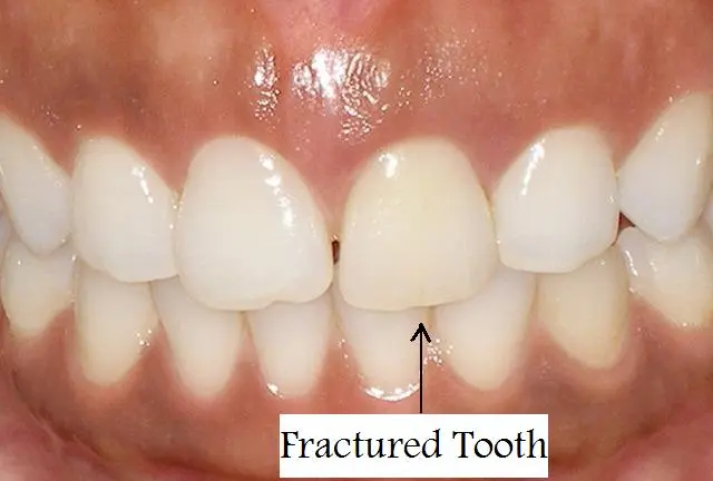 Patient with fractured tooth - before