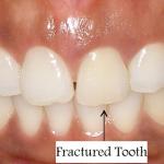 Patient with fractured tooth - before