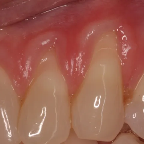 Gum graft - before procedure