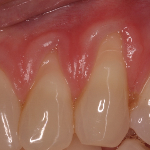 Gum graft - before procedure