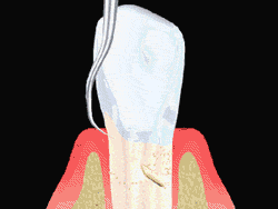 Animated illustration of root planing