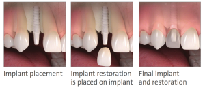 Metal-free dental implants