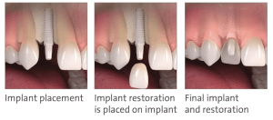 Metal-free dental implants