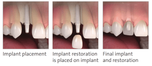 Metal-free dental implants